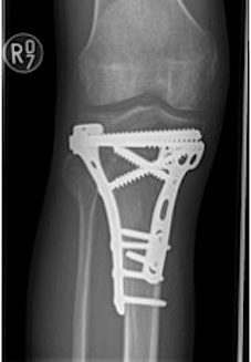 Tibial Plateau Type V ORIF AP